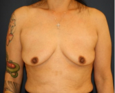 Feel Beautiful - Breast Augmentation Lift 63 - Before Photo